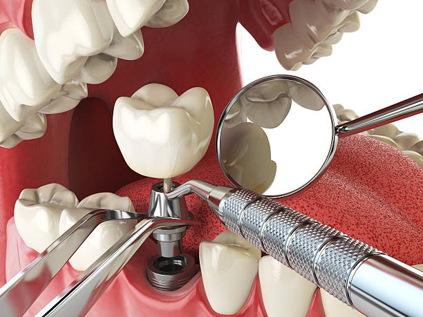Best Broken Tooth Emergency  in Mill Creek East, WA